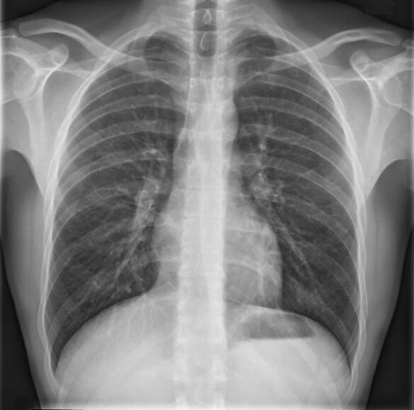 Osteochondrosis of the thoracic spine is diagnosed by x-ray