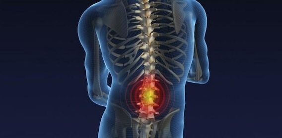 Back pain with osteochondosis of the lumbar