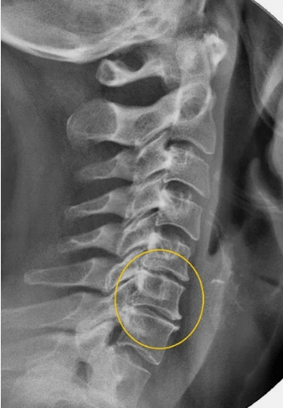 Osteochondrosis of the cervical column on a radius X