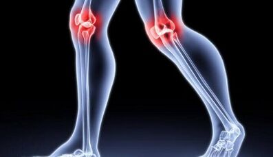 Prevention of the development of arthritis and arthrosis
