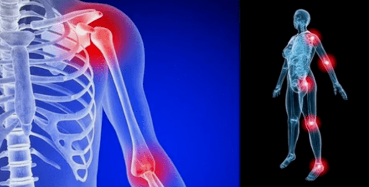 Deformation of the arts for arthrosis