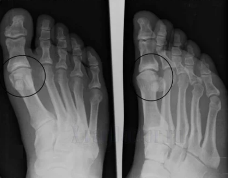Diagnosis of arthrosis