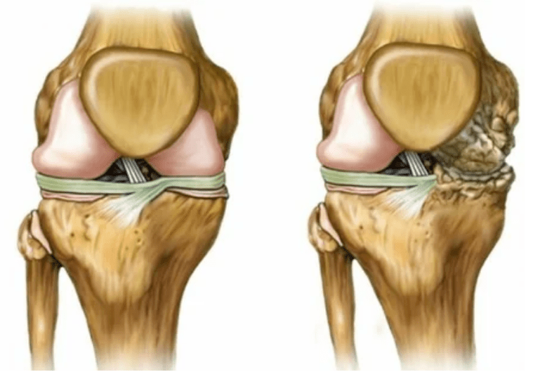 Osteoarthritis phase