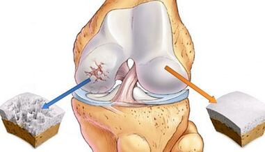 causes of arthrosis of the joints
