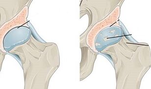 stages of development of osteoarthritis of the hip