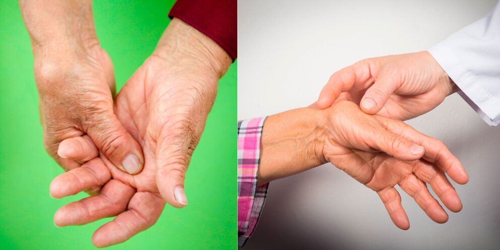 swelling and aching pains are the first signs of arthritis of the hand