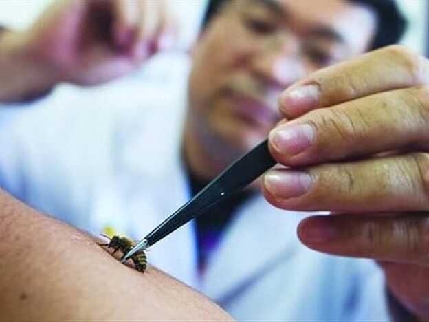 Apitherapy for cervical osteochondrosis