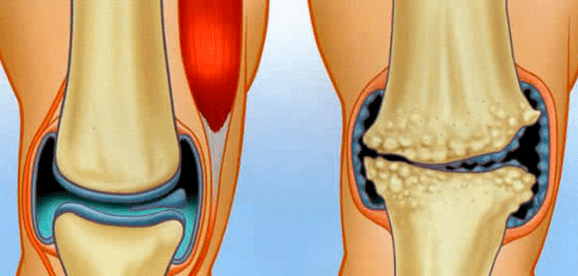 Normal joint and arthrosis
